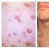 علائم و درمان التهاب پوست ختنه گاه در مردان